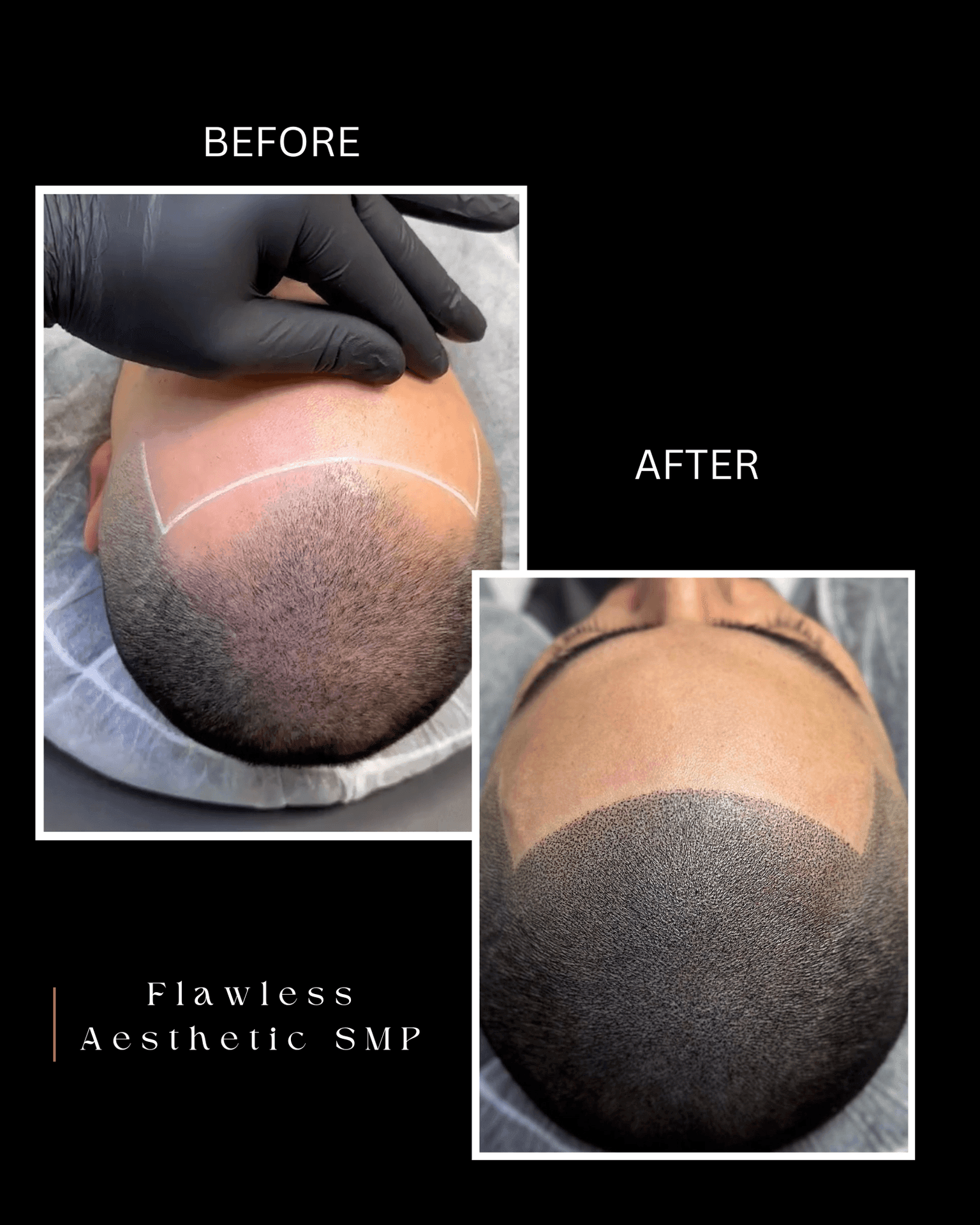 Scalp Micropigmentation (SMP)