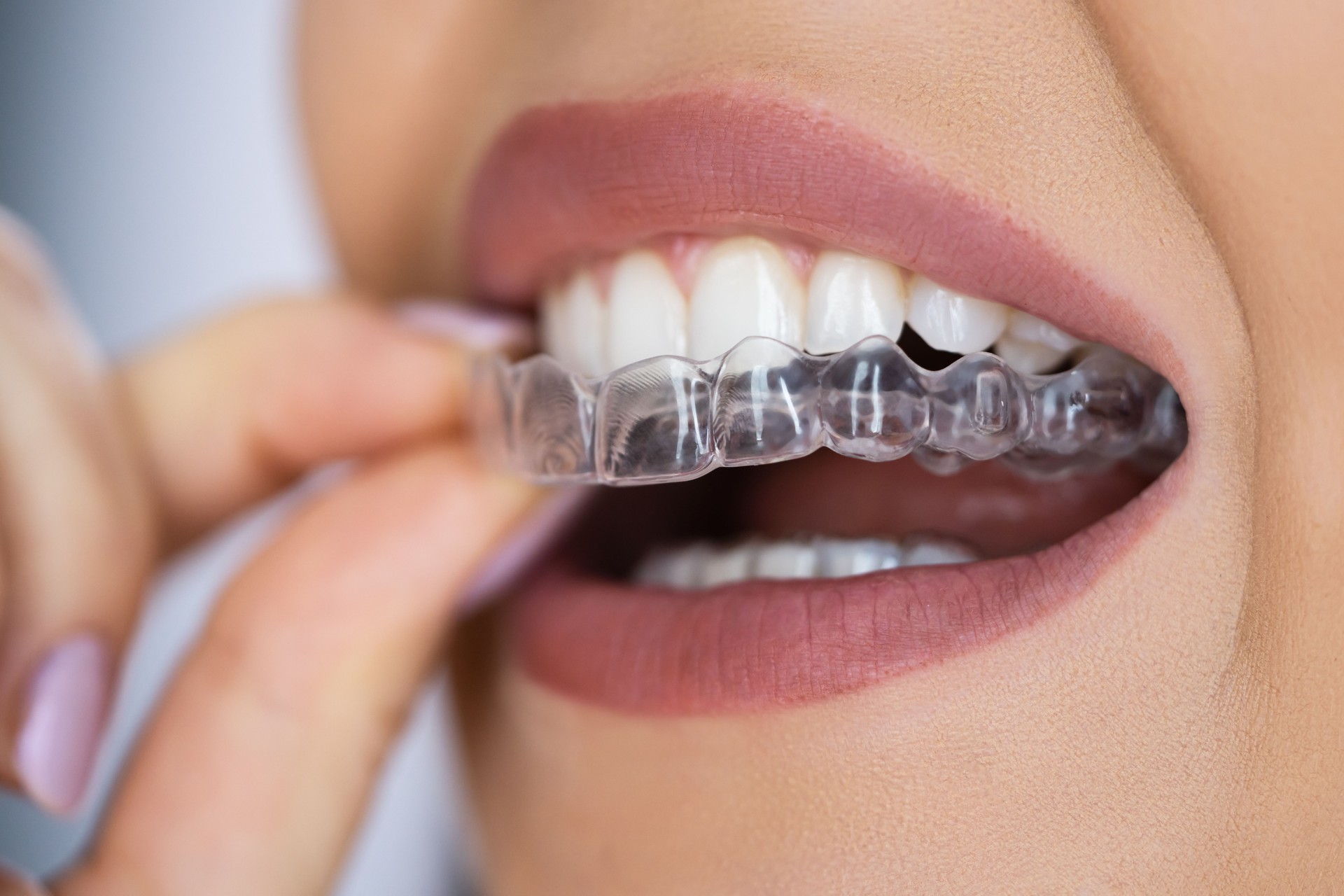 Clear Aligner Dental Night Guard